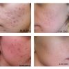 kem-tri-mun-la-roche-posay-effaclar-duo