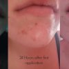 kem-tri-mun-la-roche-posay-effaclar-duo