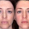 Tinh chất Paula's Choice Clinical 1% Retinol Treatment