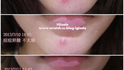 Chữa Cháy Mụn Break-out Trong 5 Ngày