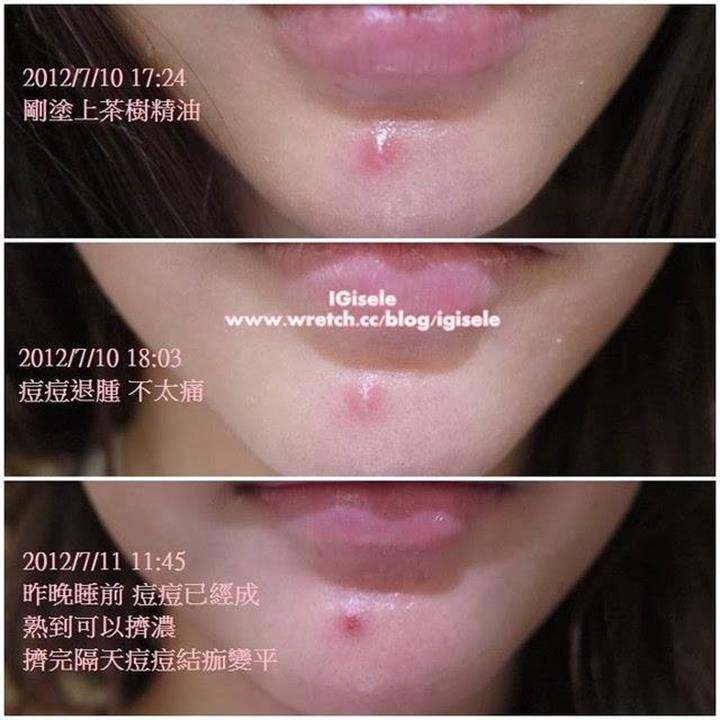 3 Cách Sử Dụng Tea Tree Oil Để Phòng Và Diệt Mụn Nhanh Gọn Nhất