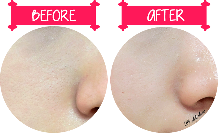 Giải quyết các vấn đề về THÂM MỤN