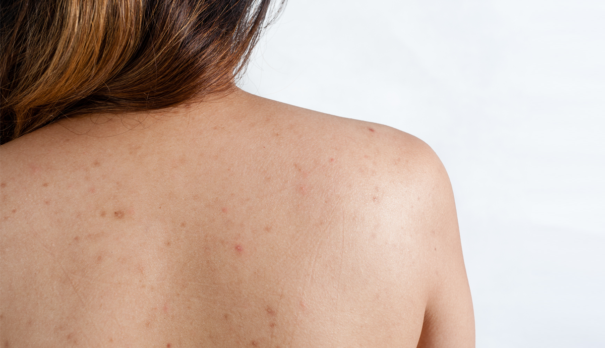 Bí Kíp Xử Lí Triệt Để Mụn Cho Cơ Thể bi-kip-xu-li-triet-de-mun-cho-co-the