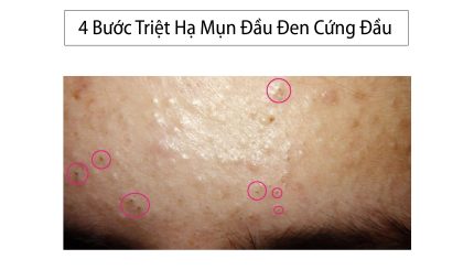 4-buoc-triet-ha-mun-dau-den-cung-dau-01