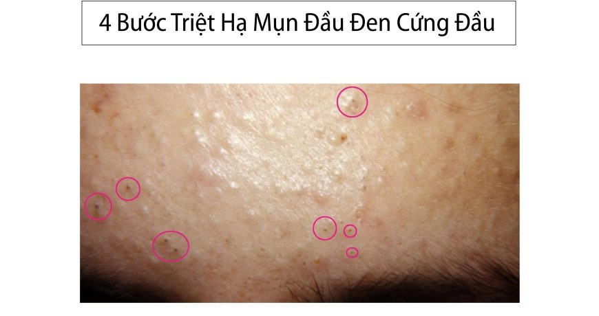 4 Bước Triệt Hạ Mụn Đầu Đen Cứng Đầu 4-buoc-triet-ha-mun-dau-den-cung-dau-01