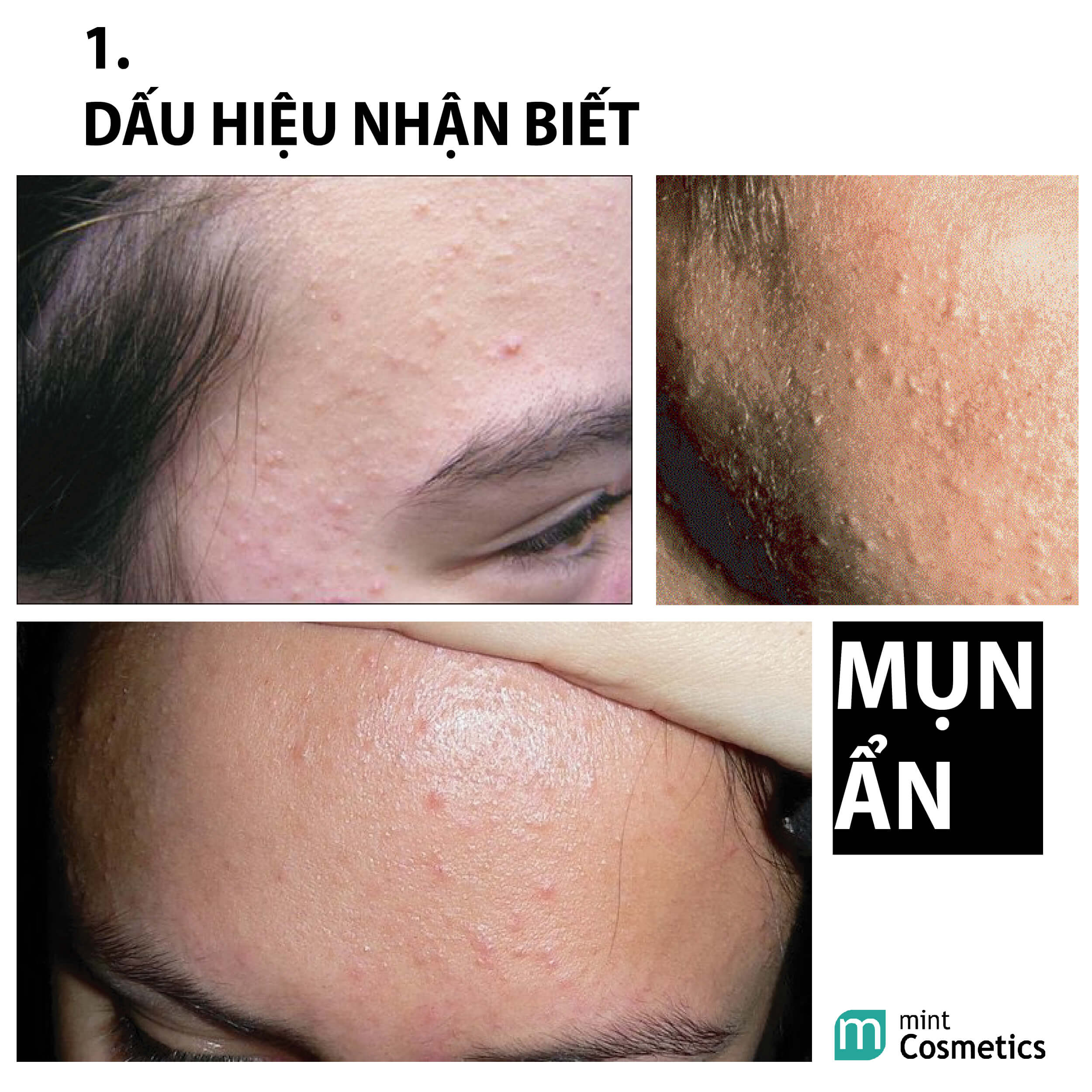 chuyen-de-dieu-tri-mun-an