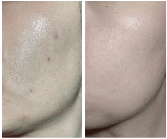 serum-tri-mun-tri-tham-naruko-tea-tree-post-blemish-corrector-10ml
