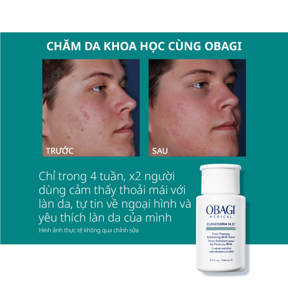Treatment Obagi Clenziderm MD Pore Therapy Exfoliating BHA Toner 148ml