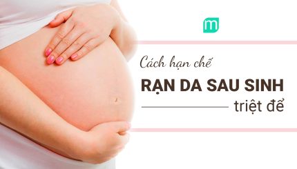 Chấm Dứt Nỗi Lo Rạn Da Sau Sinh Của Các Mẹ Bỉm Sữa