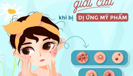 cac-buoc-giai-cuu-khi-bi-di-ung-my-pham