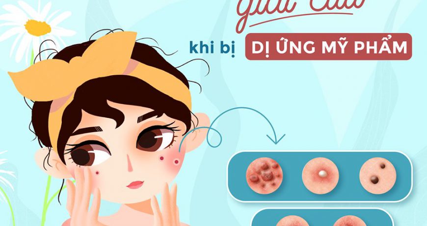 Các Bước Giải Cứu Khi Bị Dị Ứng Mỹ Phẩm cac-buoc-giai-cuu-khi-bi-di-ung-my-pham