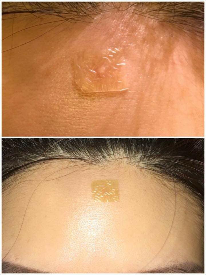 review-mieng-dan-mun-duoderm1