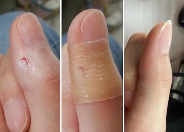 review-mieng-dan-mun-duoderm1