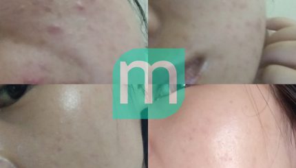 Nhìn Lại Hành Trình 5 Tháng Trị Mụn nhin-lai-hanh-trinh-5-thang-tri-mun2