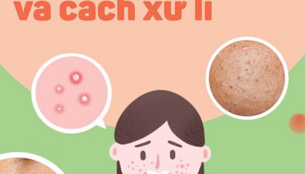 Các Loại Mụn Tuyệt Đối Không Nặn Và Cách Xử Lý cac-loai-mun-tuyet-doi-khong-nan-va-cach-xu-ly