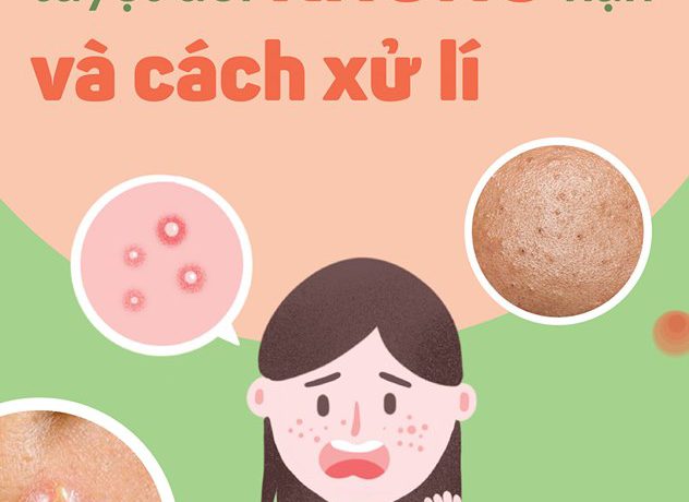 Các Loại Mụn Tuyệt Đối Không Nặn Và Cách Xử Lý cac-loai-mun-tuyet-doi-khong-nan-va-cach-xu-ly