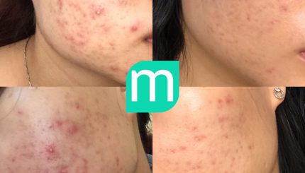 review-routine-tri-mun-viem-trong-2-thang