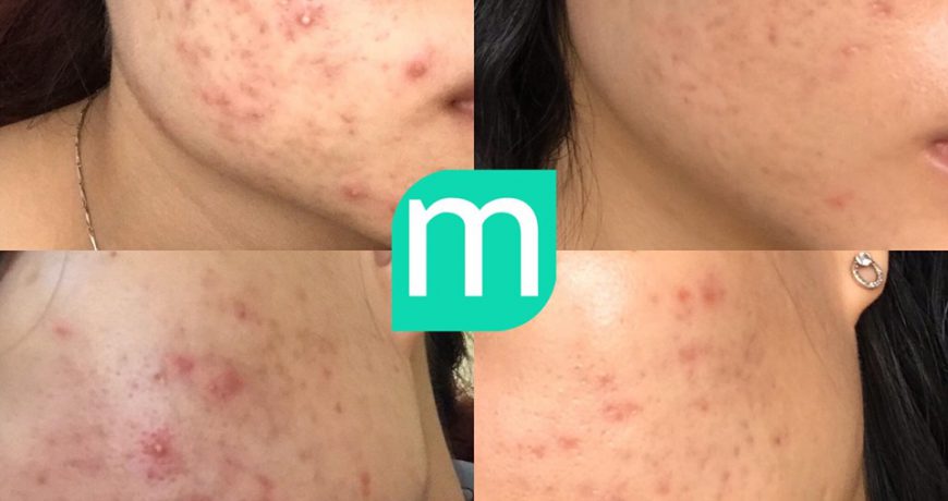 review-routine-tri-mun-viem-trong-2-thang