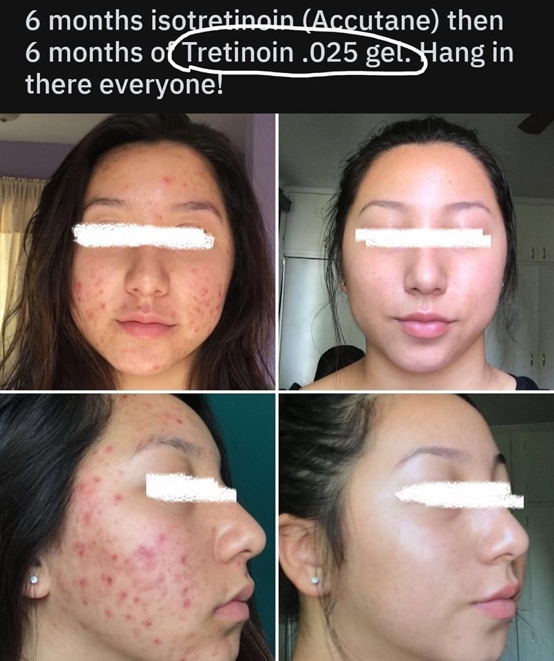 nhung-feedback-dang-kinh-ngac-sau-khi-su-dung-retinol7