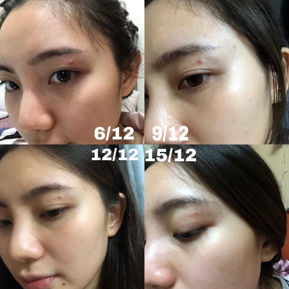 Review Tinh Chất Ngừa Mụn Meishoku Essence review-tinh-chat-ngua-mun-meishoku-essence