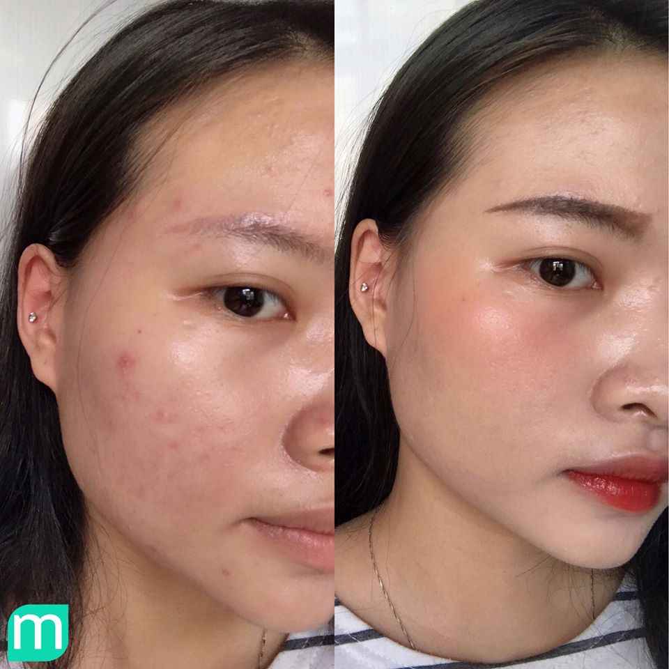 Make Up Nhẹ Nhàng Tăng Độ Tự Tin Cho Cô Nàng Da Mụn make-up-nhe-nhang-tang-do-tu-tin-cho-co-nang-da-mun