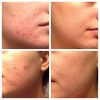 set-murad-tri-mun-blemish-control-power-couple3