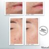 set-murad-tri-mun-blemish-control-power-couple3