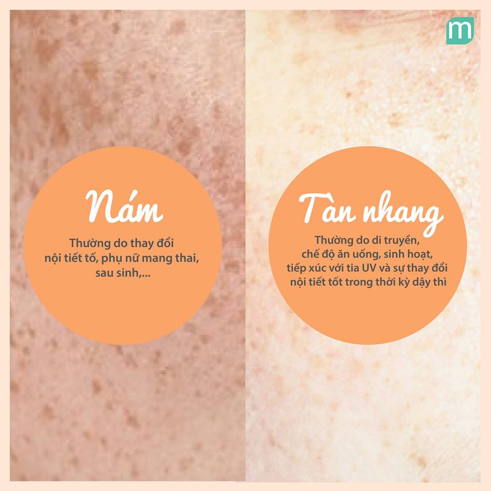 Bạn Cần Trị Nám Hay Cần Trị Tàn Nhang? ban-can-tri-nam-hay-can-tri-tan-nhang1