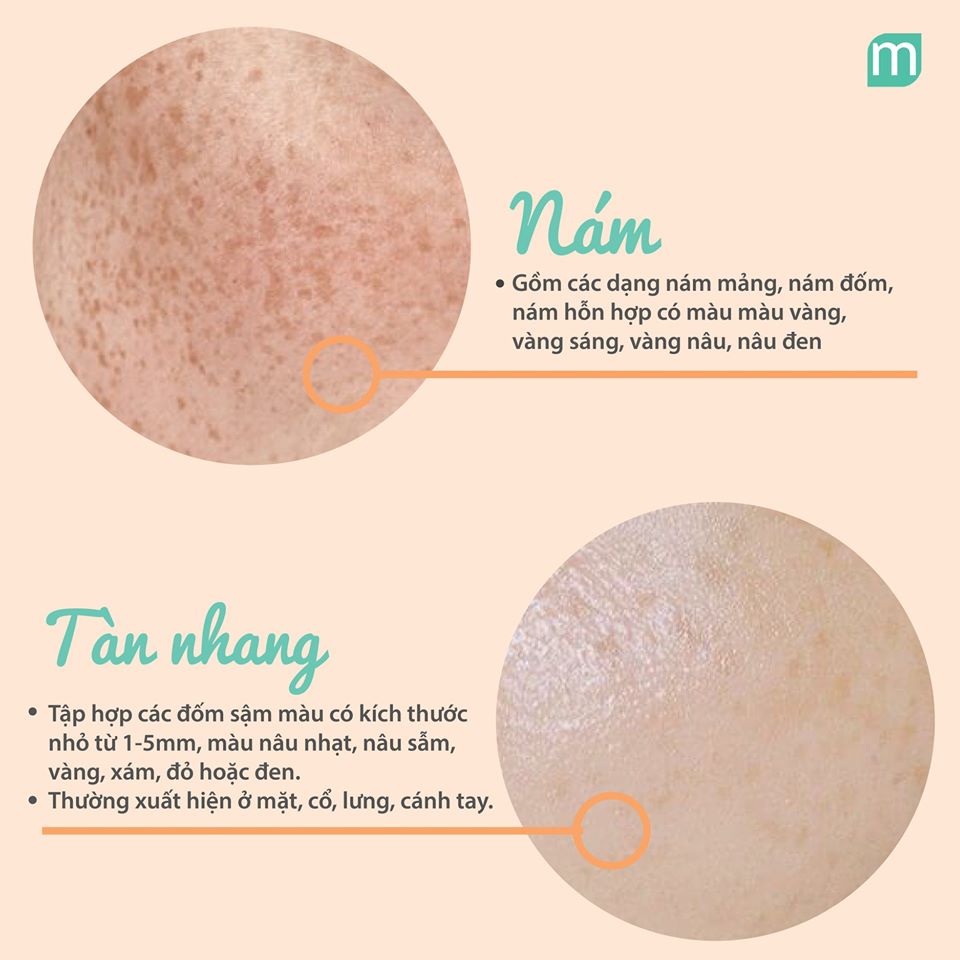 Bạn Cần Trị Nám Hay Cần Trị Tàn Nhang? ban-can-tri-nam-hay-can-tri-tan-nhang2