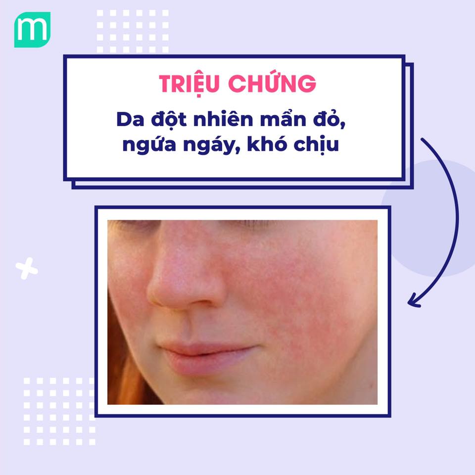 lam-gi-khi-da-bi-di-ung-thoi-tiet1