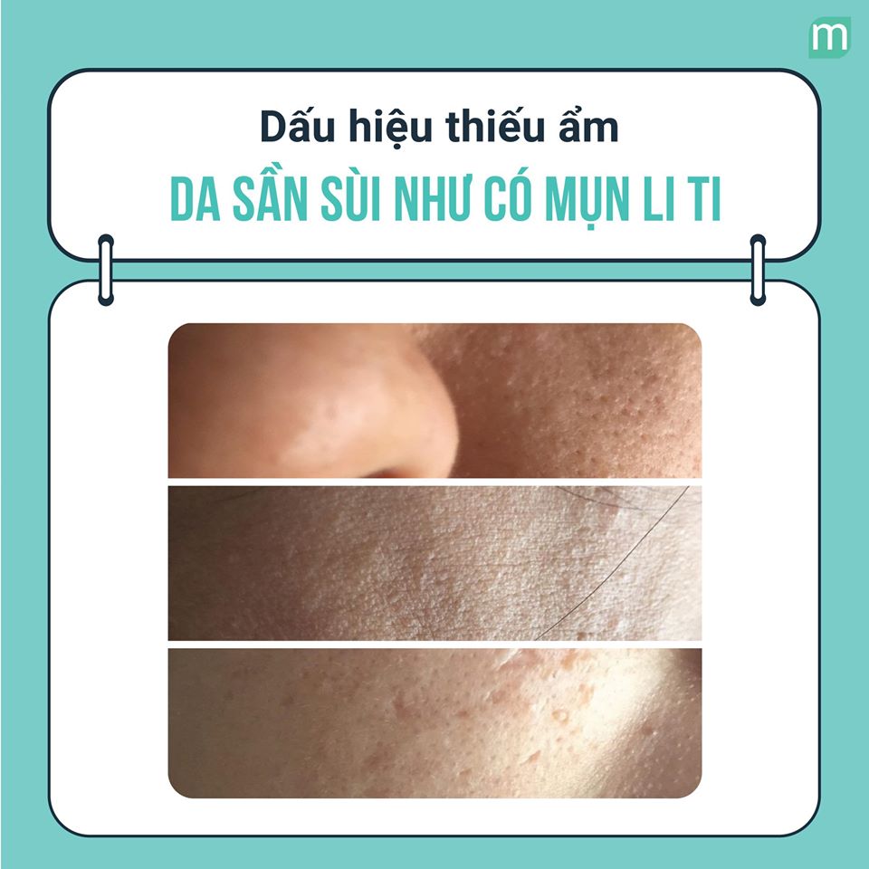 nhung-dau-hieu-da-ban-dang-thieu-am-chu-khong-phai-len-mun