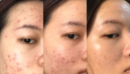 routine-sang-toi-ket-hop-voi-retinol-tri-mun