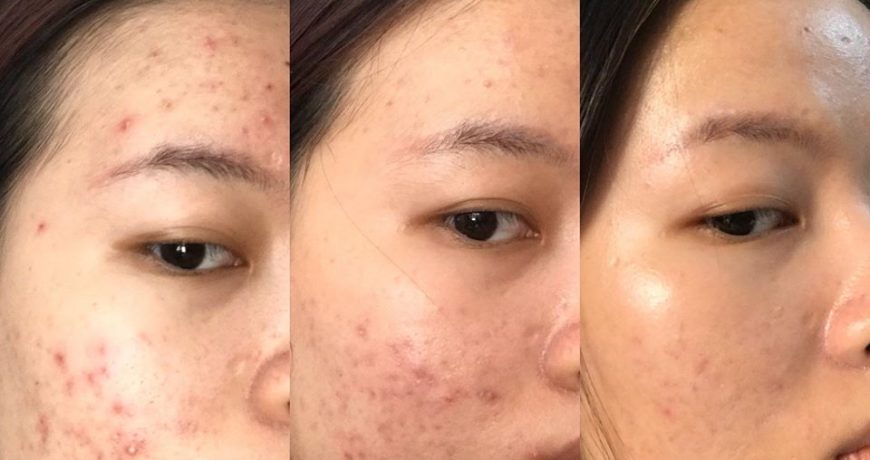 Routine Sáng Tối Kết Hợp Với Retinol Trị Mụn routine-sang-toi-ket-hop-voi-retinol-tri-mun