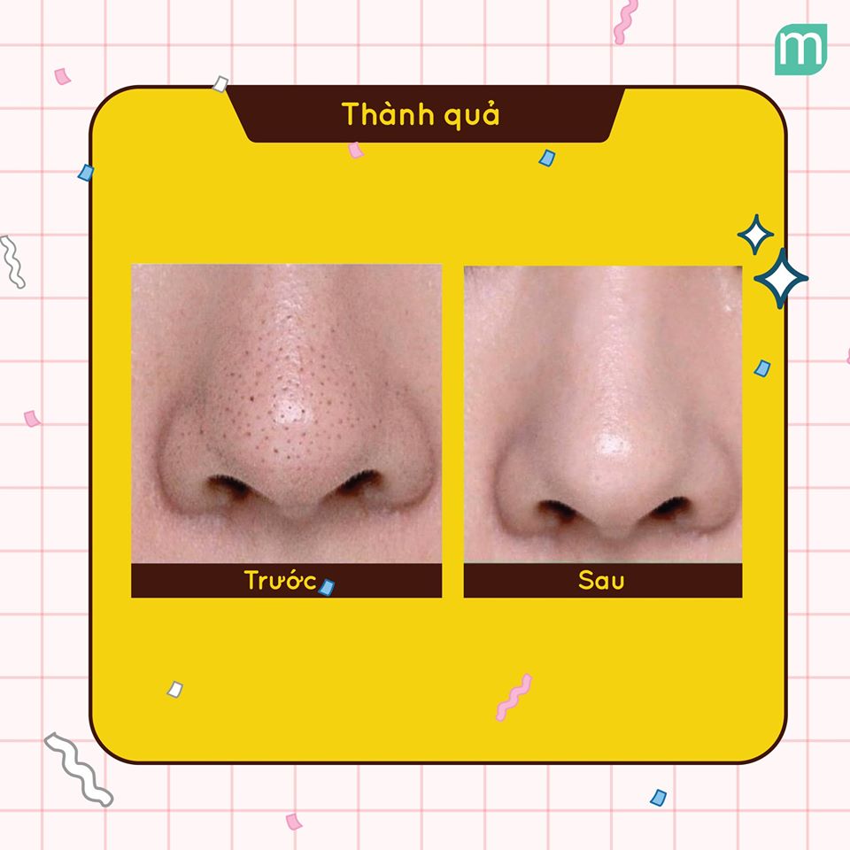 Tóm Gọn Routine Trị Mụn Đầu Đen Trong 2 Bước Tóm Gọn Routine Trị Mụn Đầu Đen Trong 2 Bước