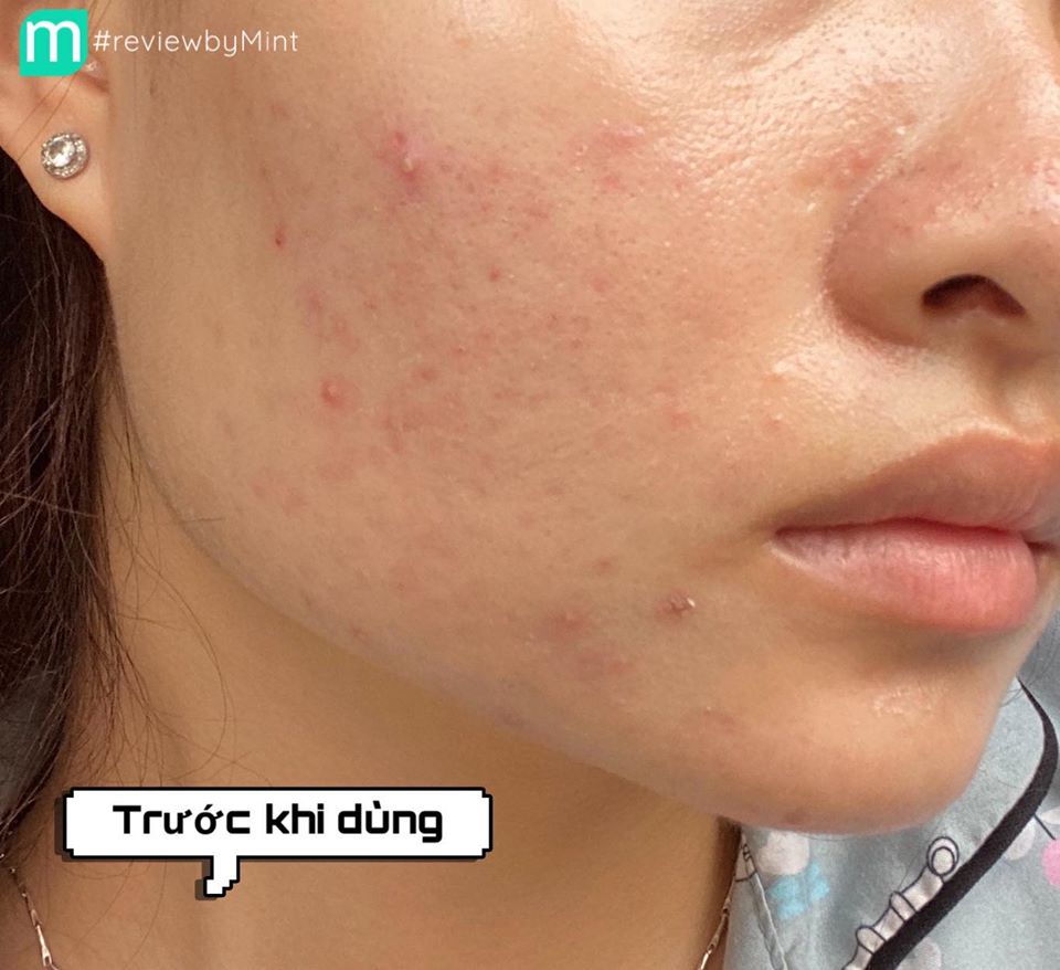 review-naruko-tea-tree-precious-lotion-2-lop