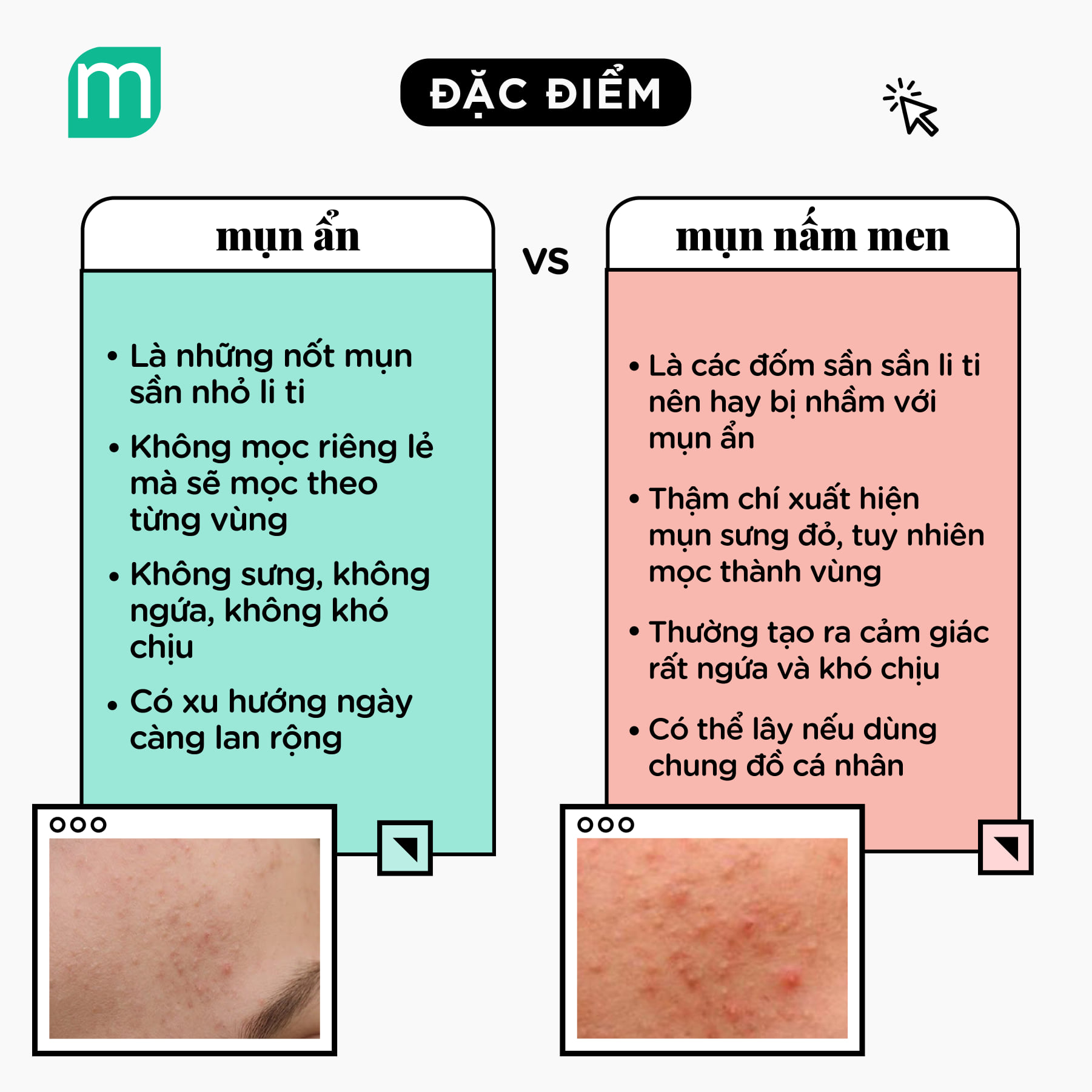 Bạn Có Đang Nhầm Lẫn Giữa Mụn Ân Và Mụn Nấm Men? ban-co-dang-nham-lan-giua-mun-an-va-mun-nam-men