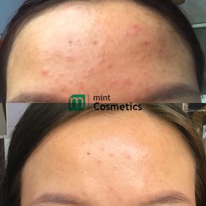 Treatment Obagi Tretinoin 0.025% Cream