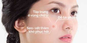 Tinh chất Acnes 25+ Facial Serum 20ml