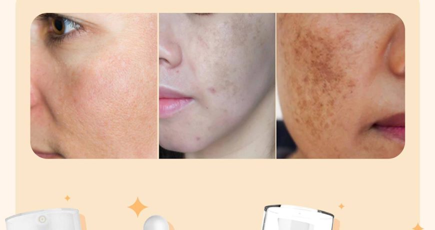 Tổng Hợp Các Serum Trị Nám “quyền lực” Tại Mint