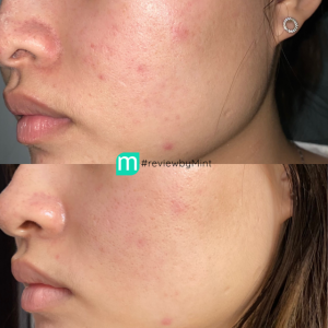 Mặt Nạ Làm Dịu Mediheal P.D.F AC-Dressing Ampoule Mask EX 25ml