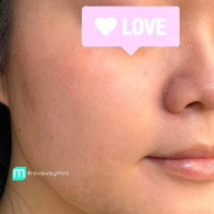 Serum Ngừa Mụn Balance Niacinamide 15% Blemish Recovery 30ml