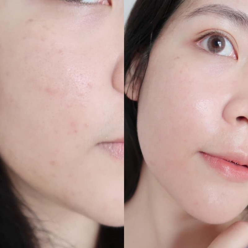 ACNE STUDIO by PMT: Tiên phong kiểm soát mụn không dùng thuốc tại Việt Nam