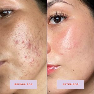Xịt Ngừa Mụn Tower 28 SOS Daily Rescue Facial Spray