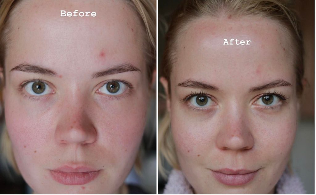Serum Vichy Normaderm Probio BHA Anti Imperfections 30ml Serum Vichy Normaderm Probio BHA Anti Imperfections 30ml