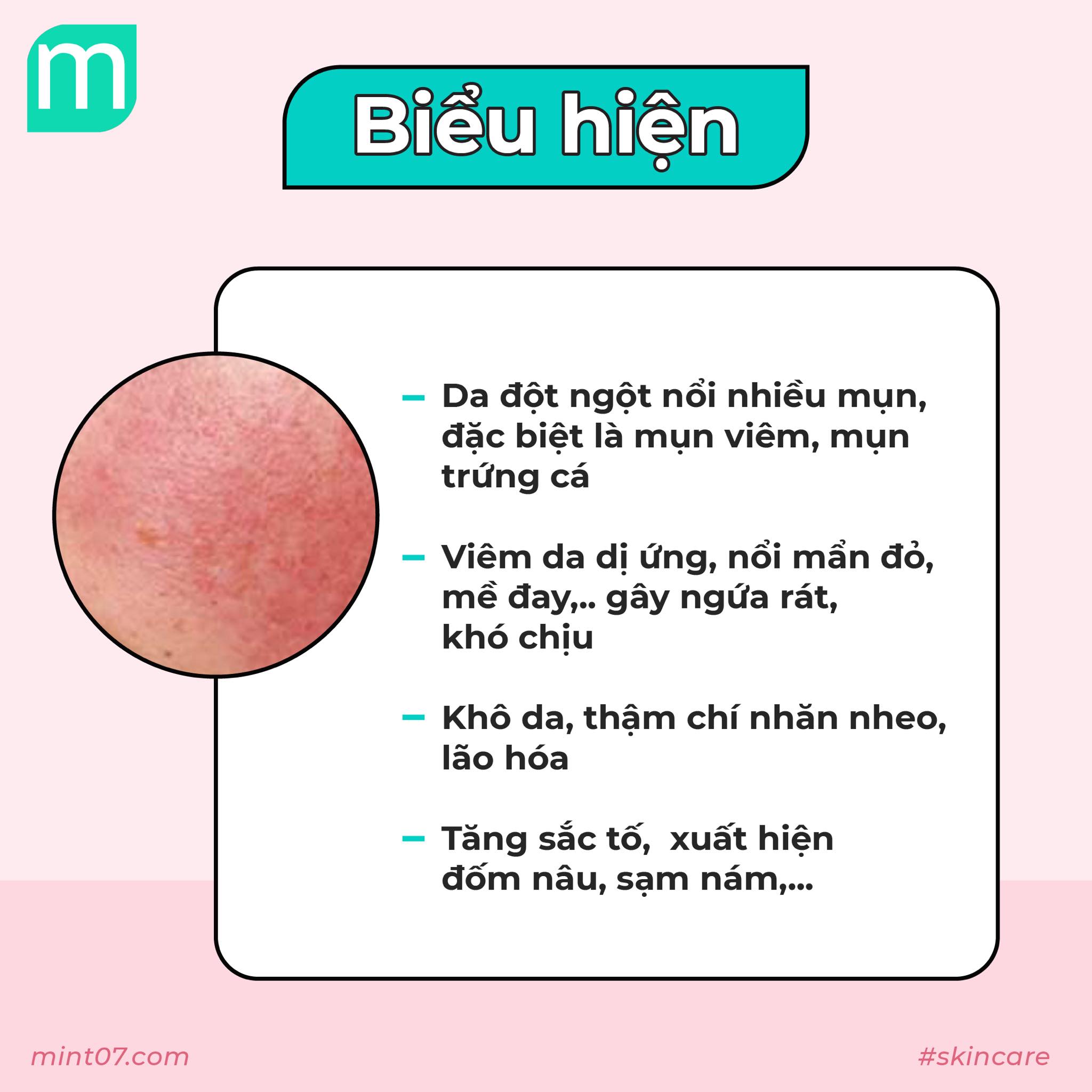 Chuyên Đề Kích Ứng Mỹ Phẩm Và Cách Xử Lý