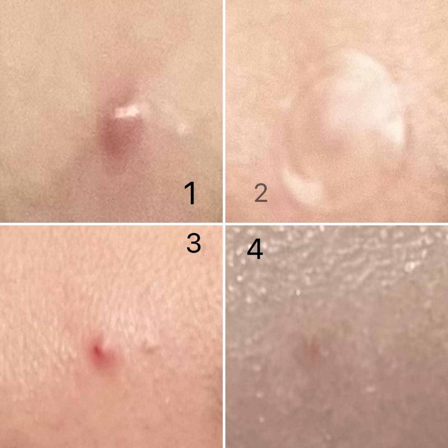 Review: Chấm Mụn + Dán Mụn Some By Mi 