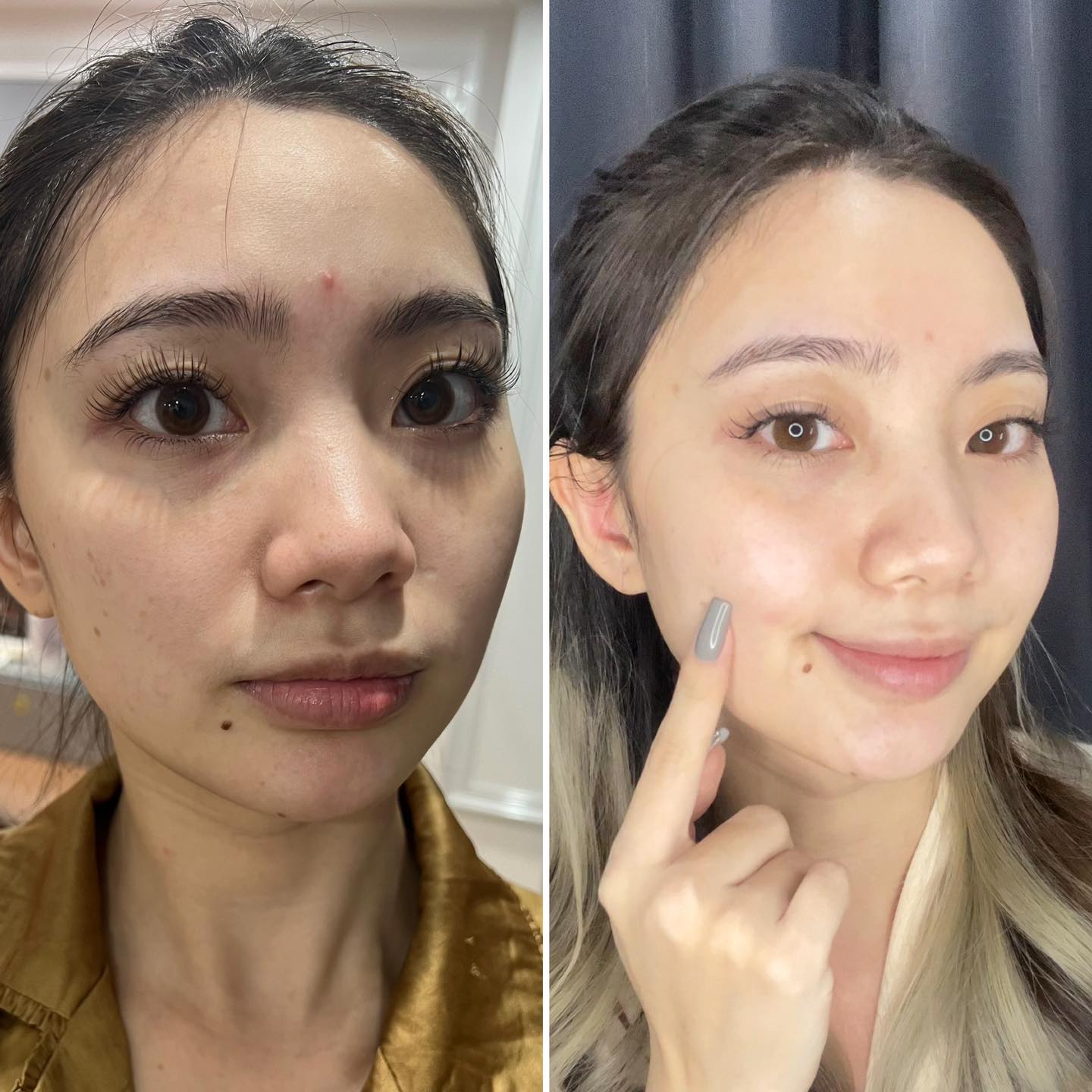Review: Chấm Mụn + Dán Mụn Some By Mi 