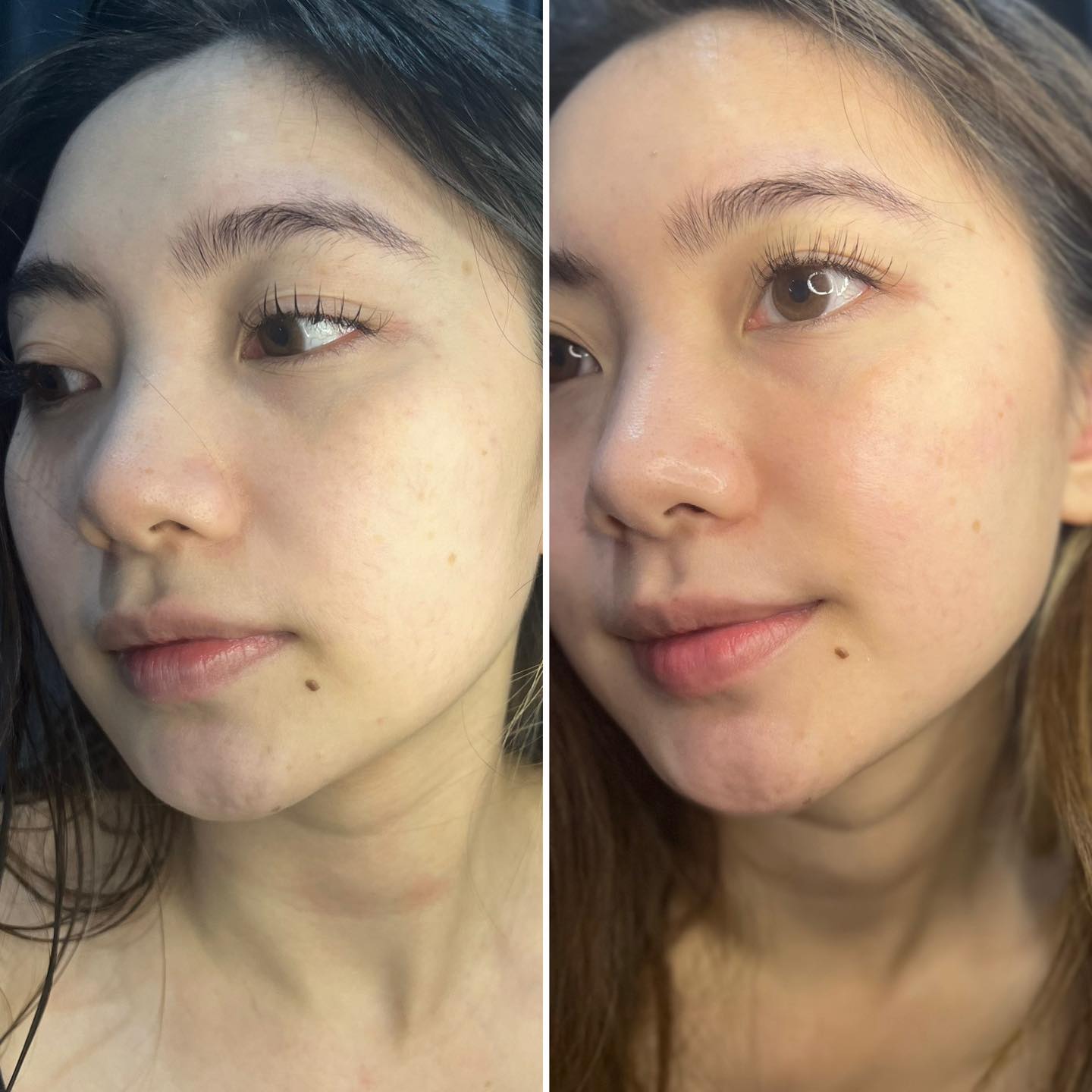 "Bộ Đôi" Chuyên Giải Cứu Da Sần, Lỗ Chân Lông "Hố Bom"