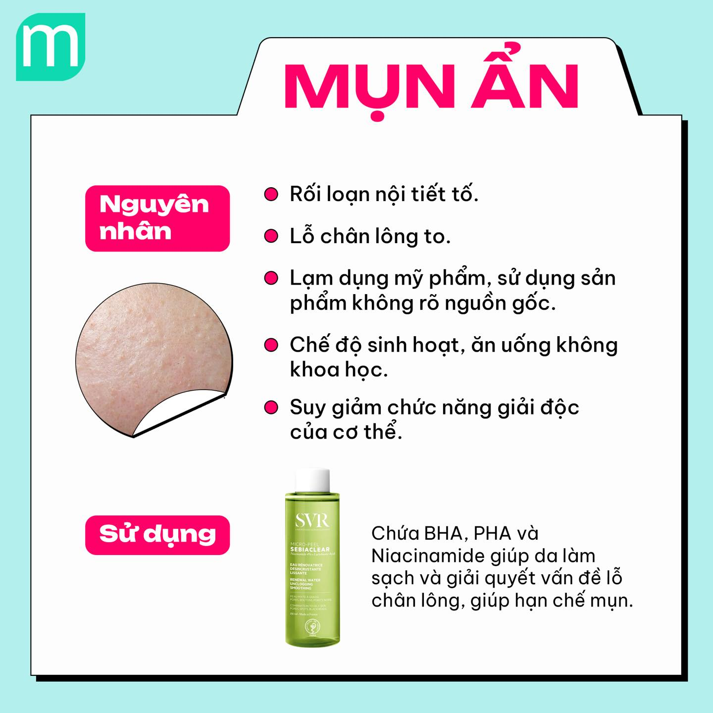 4 dạng mụn phổ biến và cách xử lý cơ bản