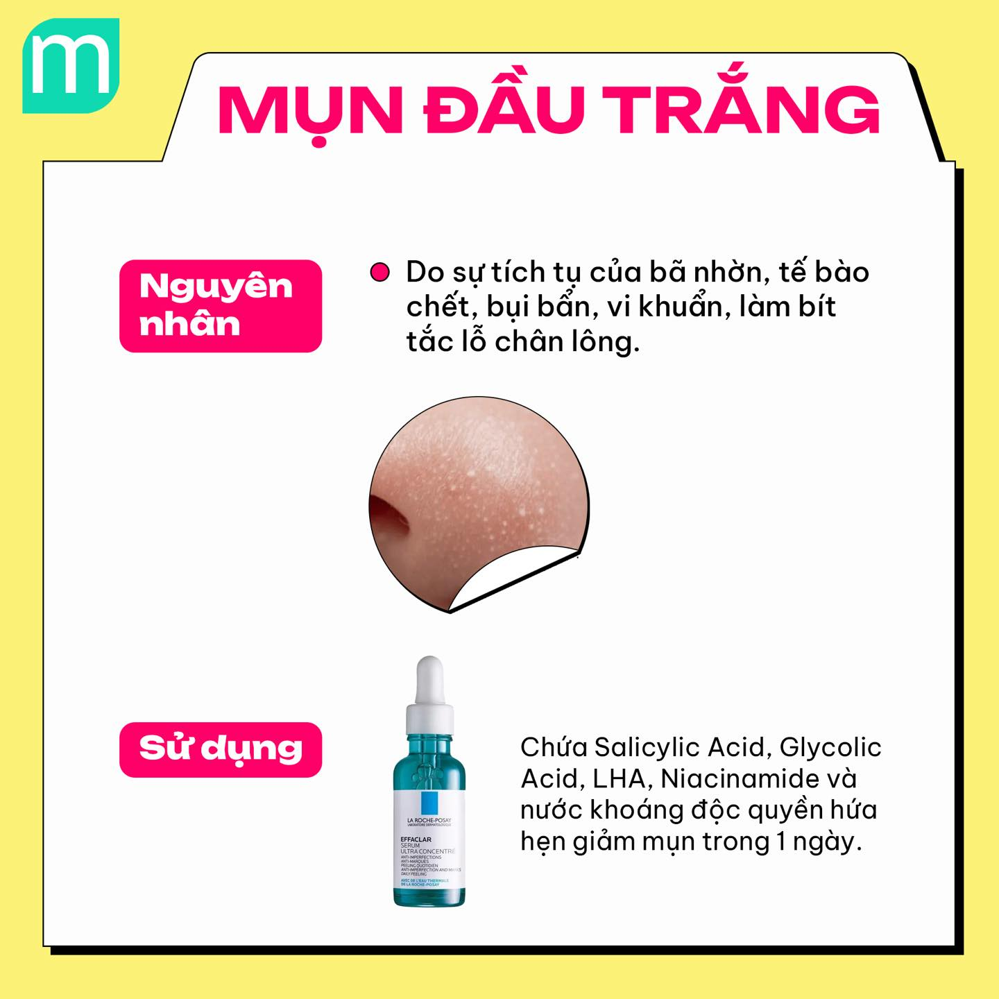 4 dạng mụn phổ biến và cách xử lý cơ bản